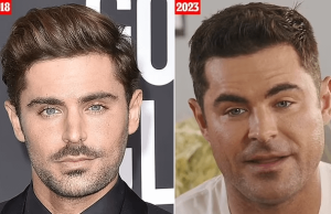 What Happened To Zac Efron'S Face?